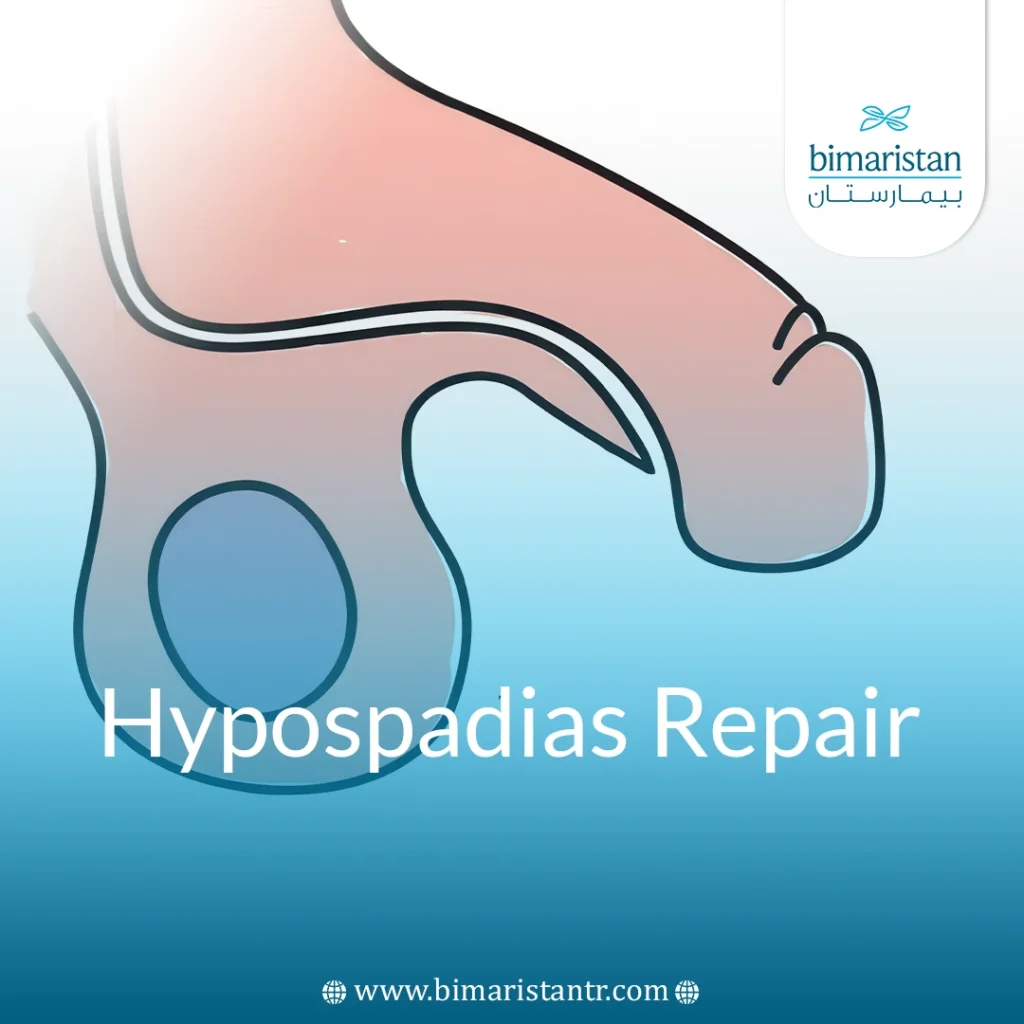 Hypospadias Repair