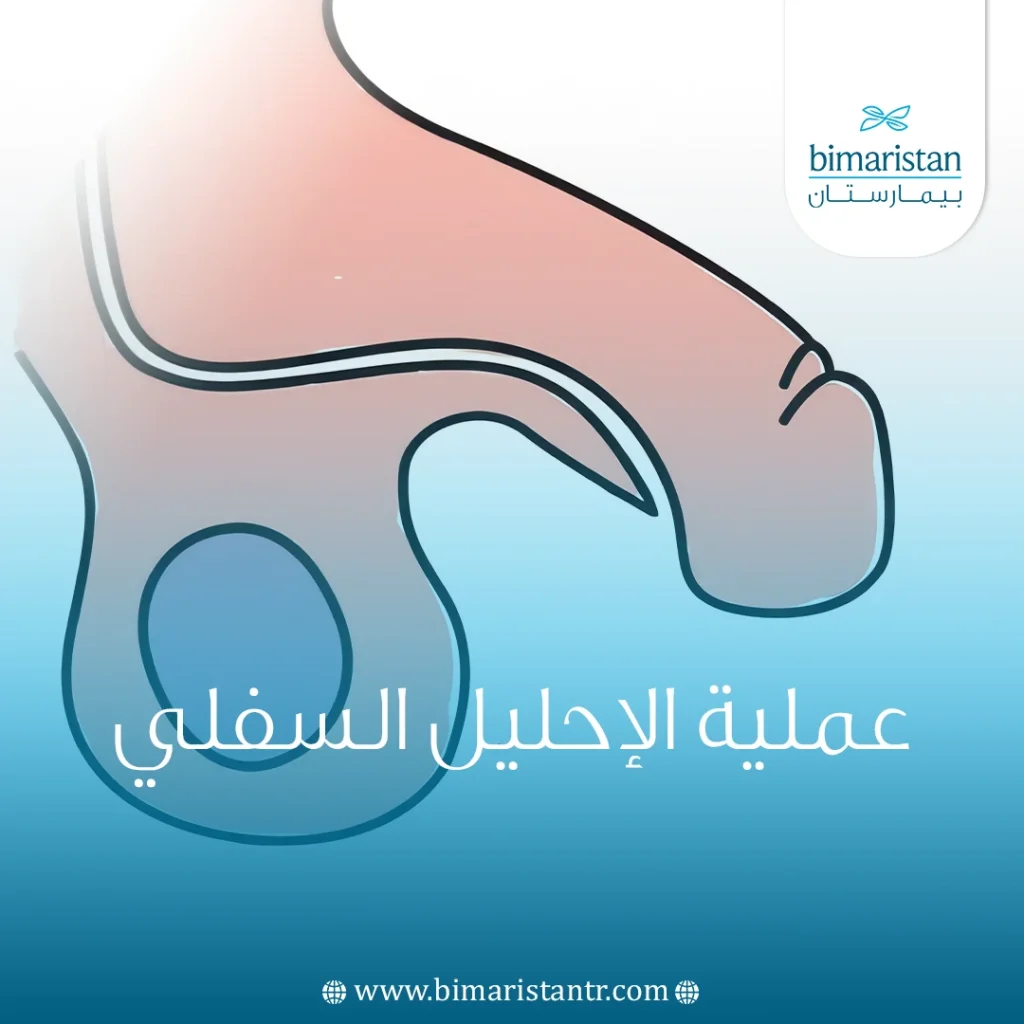 عملية الإحليل السفلي