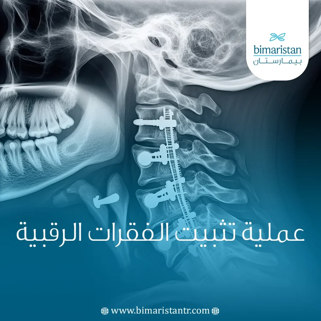 عملية تثبيت الفقرات الرقبية