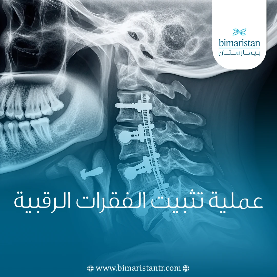 عملية تثبيت الفقرات الرقبية
