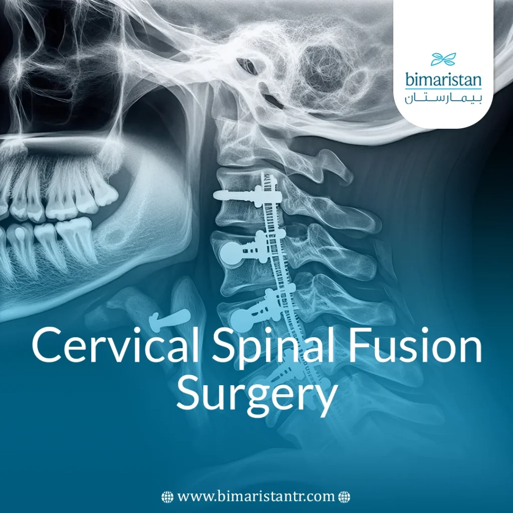 Cervical Spine Fusion