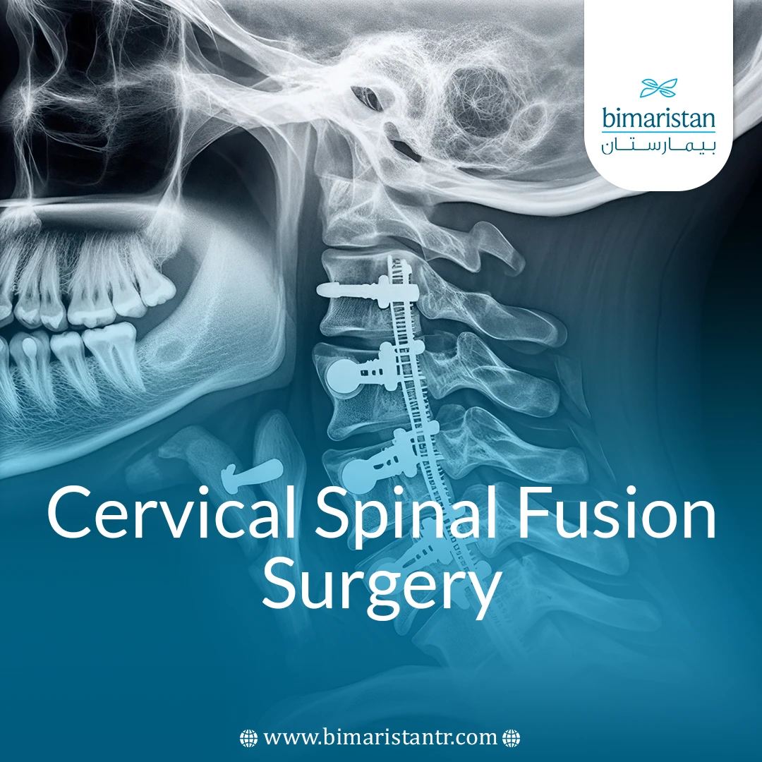 Cervical Spine Fusion
