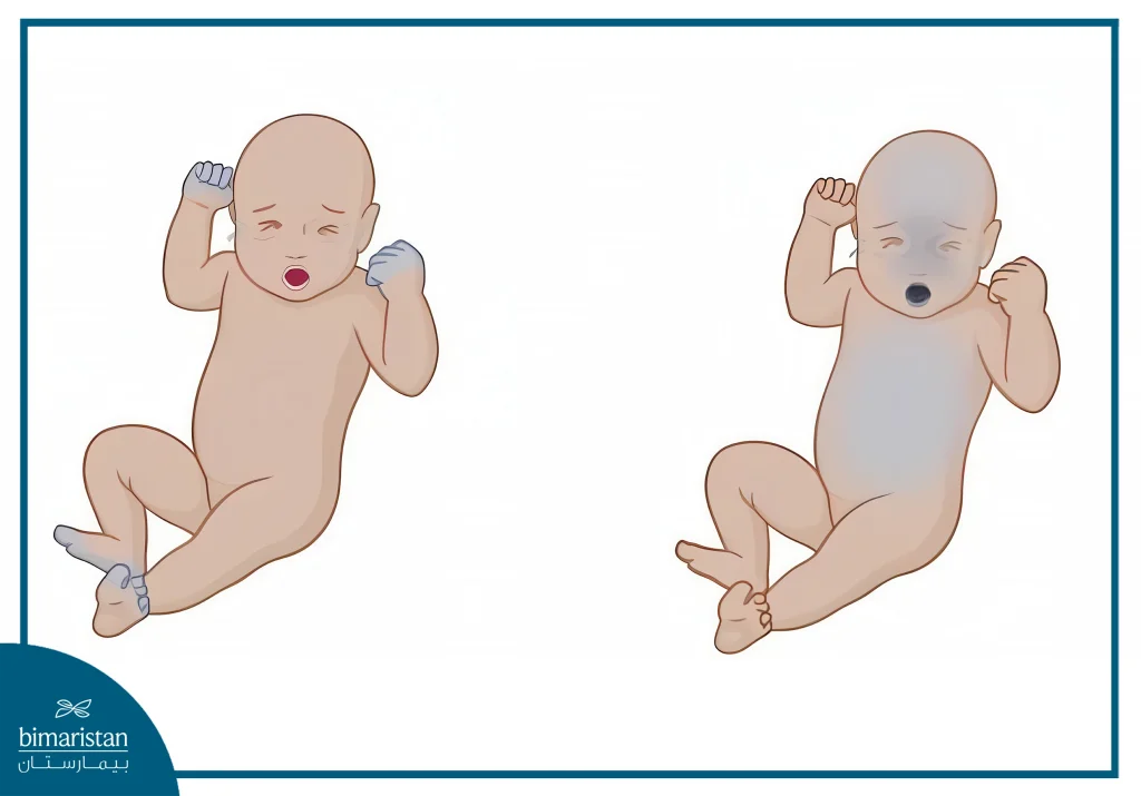 Symptoms Of Heart Disease In Newborns: Early Signs &Amp; Detection Guide 4 Cyanosis Is The Most Common Of The Symptoms Of Heart Disease In Newborns.