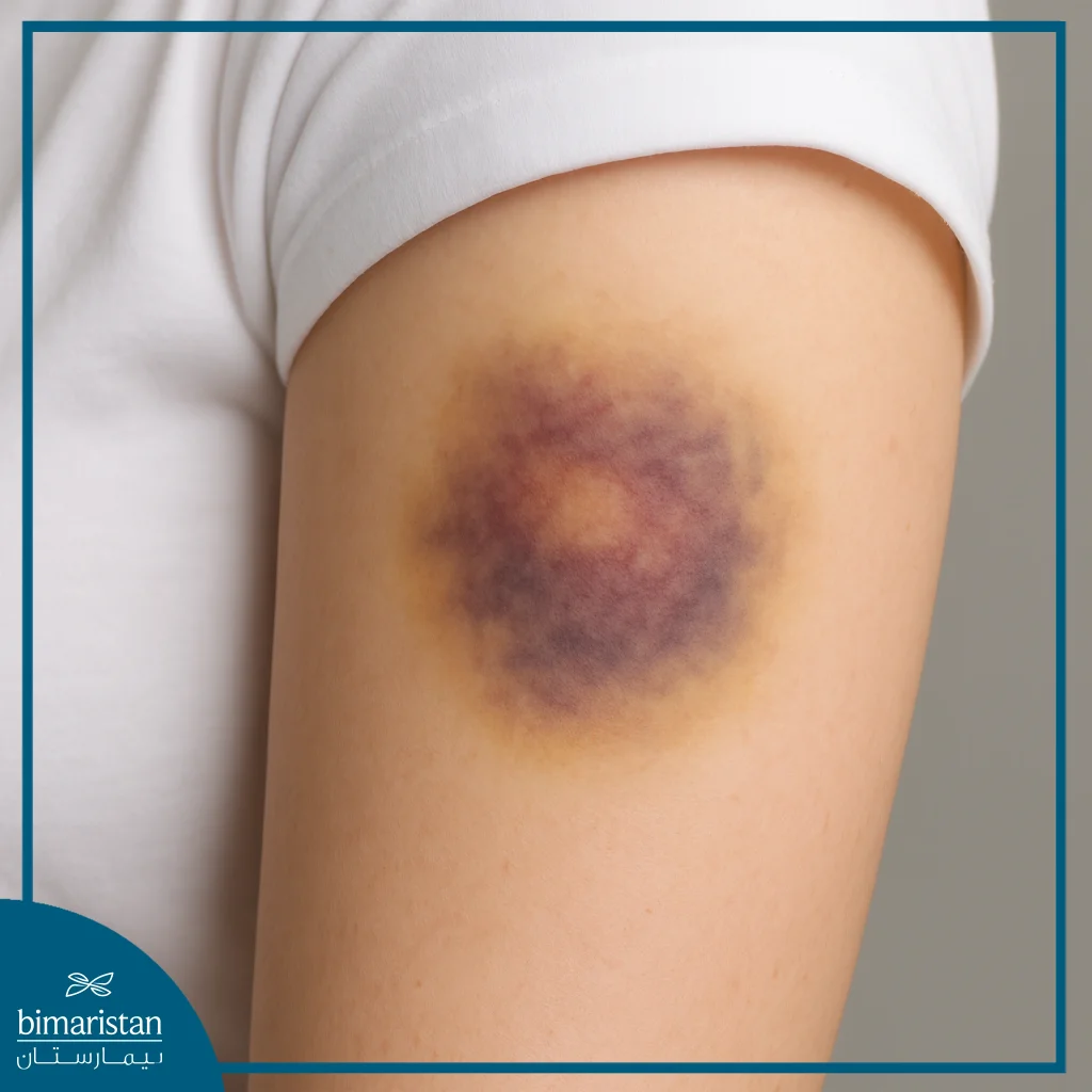 Blood Disorders: The Hidden Danger And Ways To Stay Safe 4 Bruising Due To Platelet Disorders