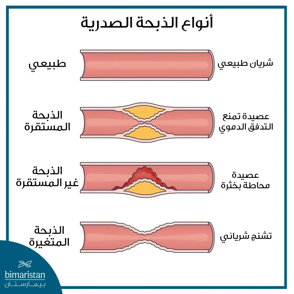 أمراض الشرايين التاجية: أهم الأسباب وطرق العلاج 3 الاختلاف بين أنواع الذبحة الصدرية في حالة أمراض الشرايين التاجية