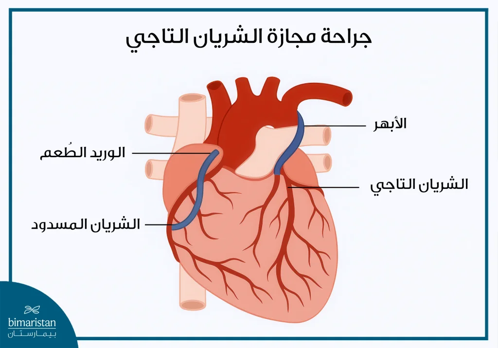 أمراض الشرايين التاجية: أهم الأسباب وطرق العلاج 5 علاج انسداد الشرايين التاجية من خلال جراحة مجازة الشريان التاجي