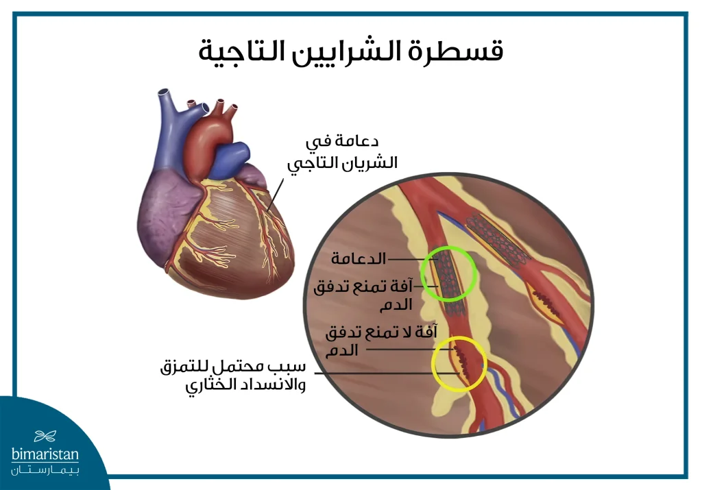 أمراض الشرايين التاجية: أهم الأسباب وطرق العلاج 4 تحسين تدفق الدم إلى عضلة القلب من خلال قسطرة الشرايين التاجية