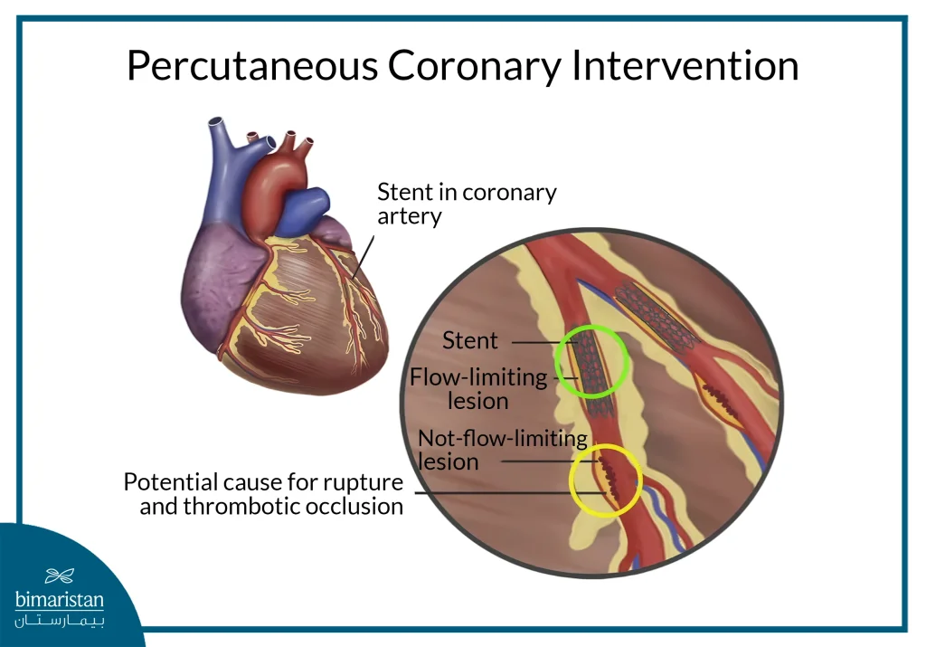 Coronary Artery Disease: Causes, Symptoms, And Best Treatment Options 4 Improving Blood Flow To The Heart Muscle Through Coronary Artery Catheterization