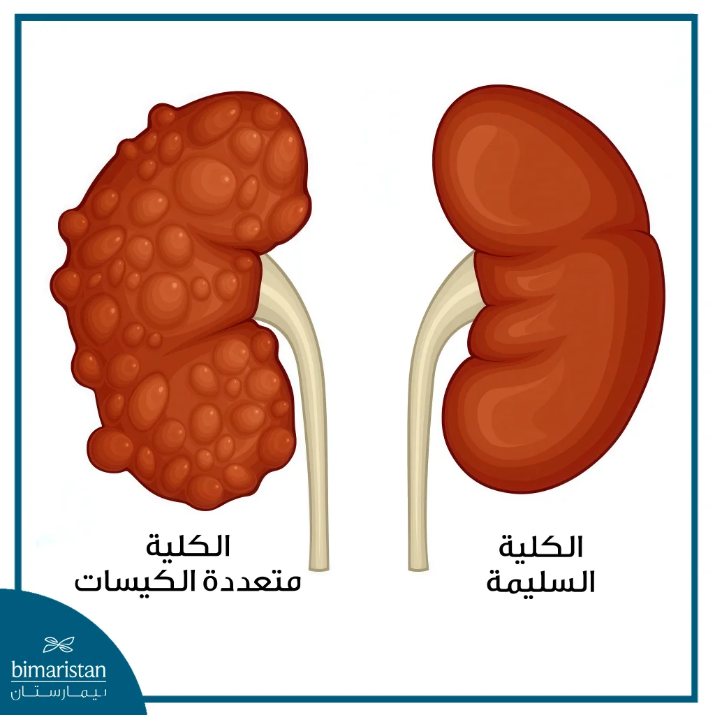 أمراض الكلى 3 الكلية متعددة الكيسات