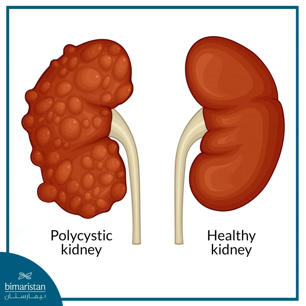Kidney Disease 2 Polycystic Kidney Disease