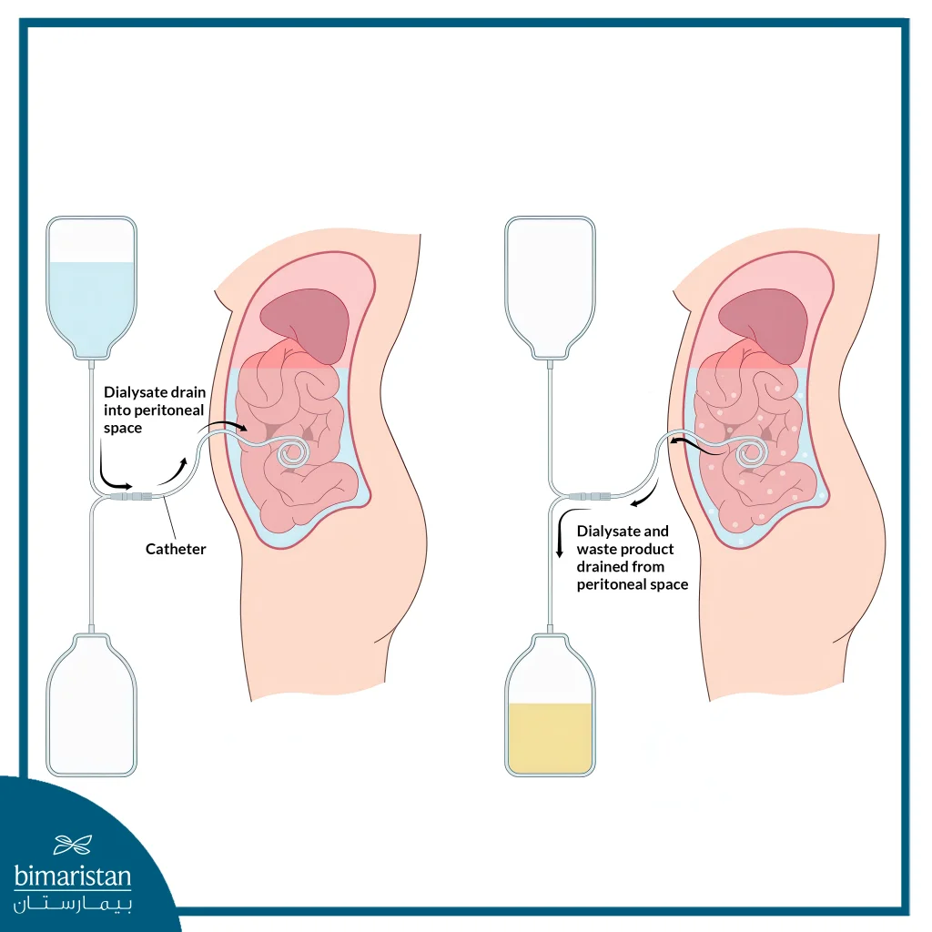 Kidney Disease 4 Peritoneal Dialysis