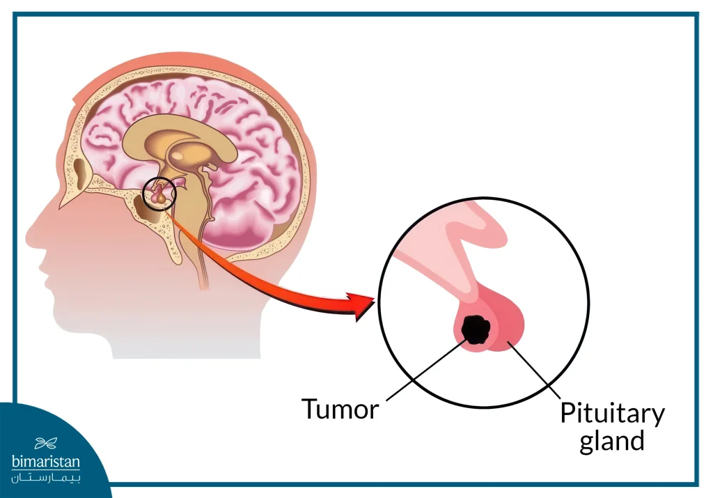 Pituitary Tumors: Causes, Symptoms &Amp; Treatment Options 3 Pituitary Tumors In Pictures