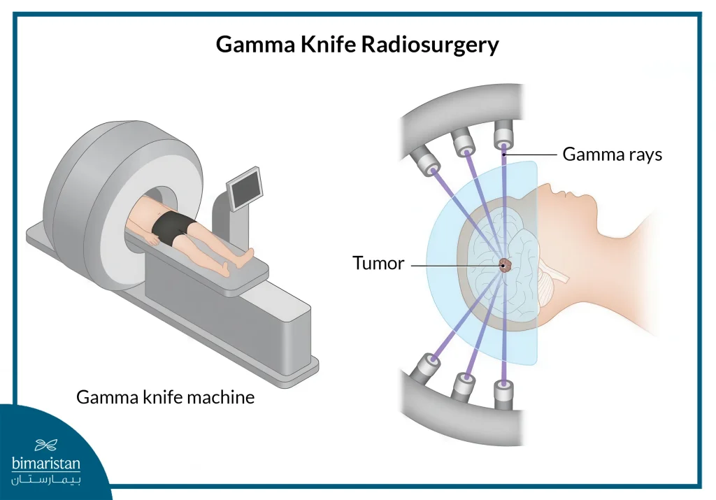 Pituitary Tumors: Causes, Symptoms &Amp; Treatment Options 5 Gamma Knife Surgery To Treat Pituitary Tumors
