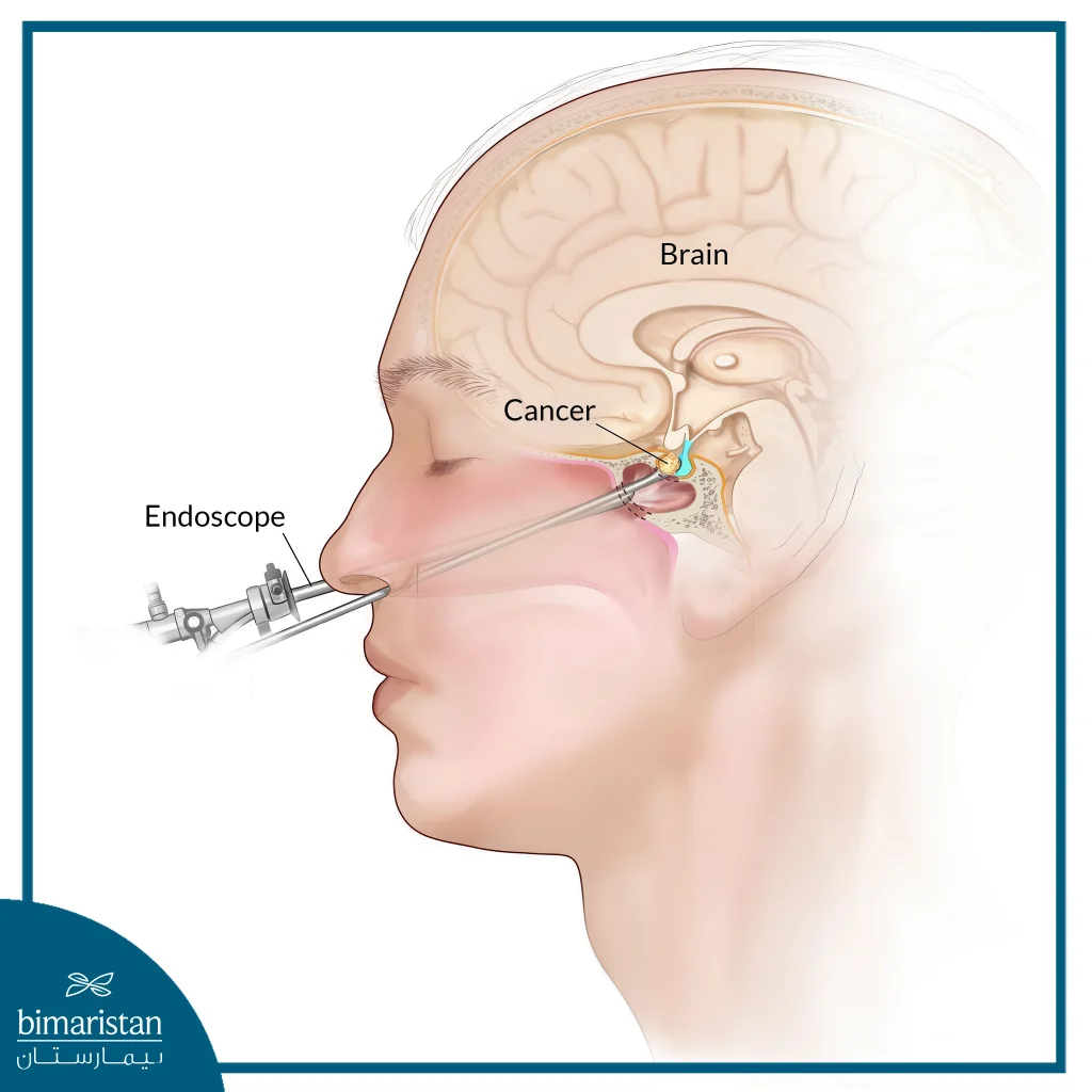 Pituitary Tumors: Causes, Symptoms &Amp; Treatment Options 4 Transsphenoidal Surgery For Pituitary Tumors