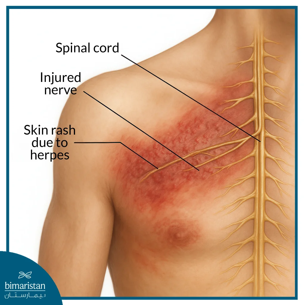 Lyrica And Tramadol Addiction: Symptoms, Risks And Treatment 2 Shingles