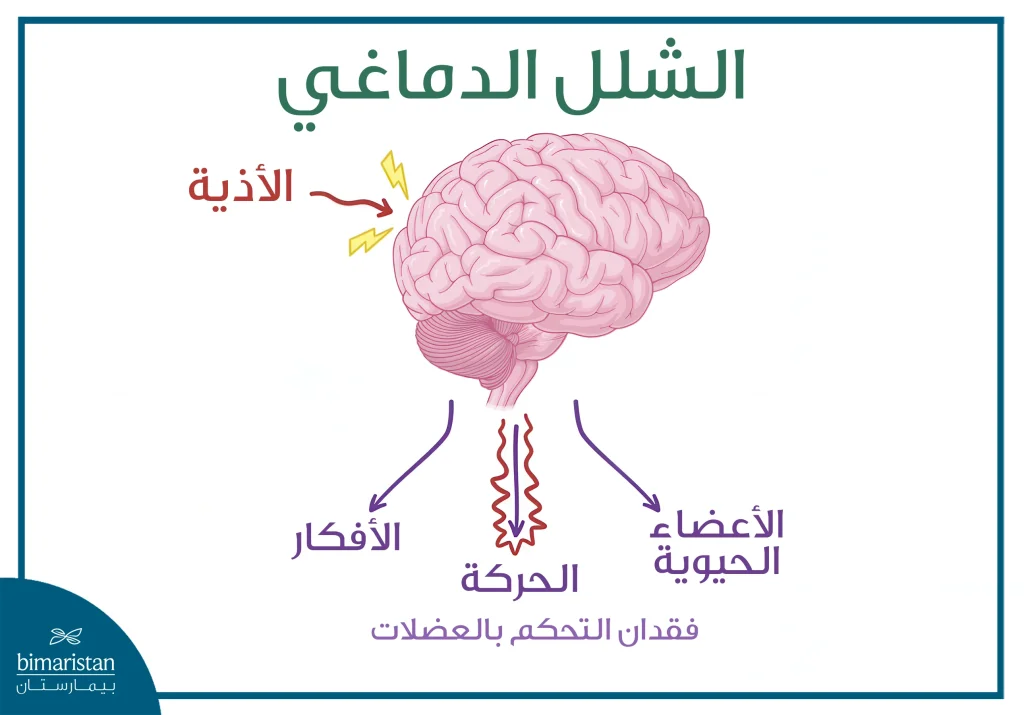 إعادة تأهيل الشلل الدماغي: خطوات لتحسين الحركة والنطق وجودة الحياة 2 صورة توضح اثر الاذية التي تصيب الدماغ وتسبب الشلل الدماغي