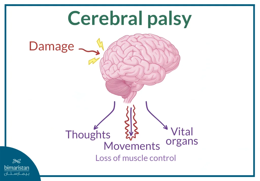 Cerebral Palsy Rehabilitation: Essential Steps To Improve Mobility, Speech And Quality Of Life 2 An Image Illustrating The Impact Of Brain Damage Leading To Cerebral Palsy