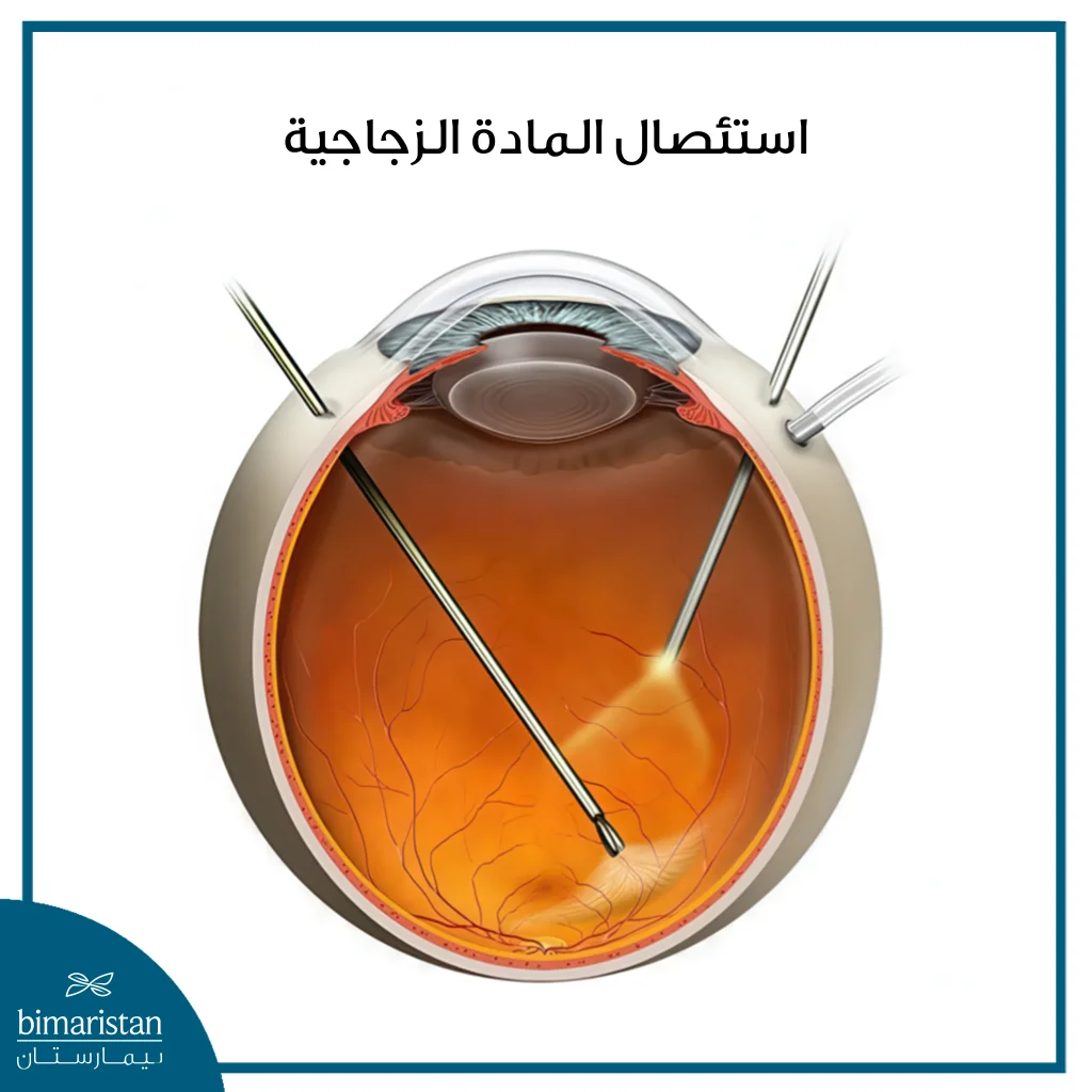 استئصال المادة الزجاجية في تركيا: متى يُجرى وما مخاطره؟ دليل شامل للمريض 2025 2 صورة توضح عملية استئصال المادة الزجاجية والأدوات المستخدمة