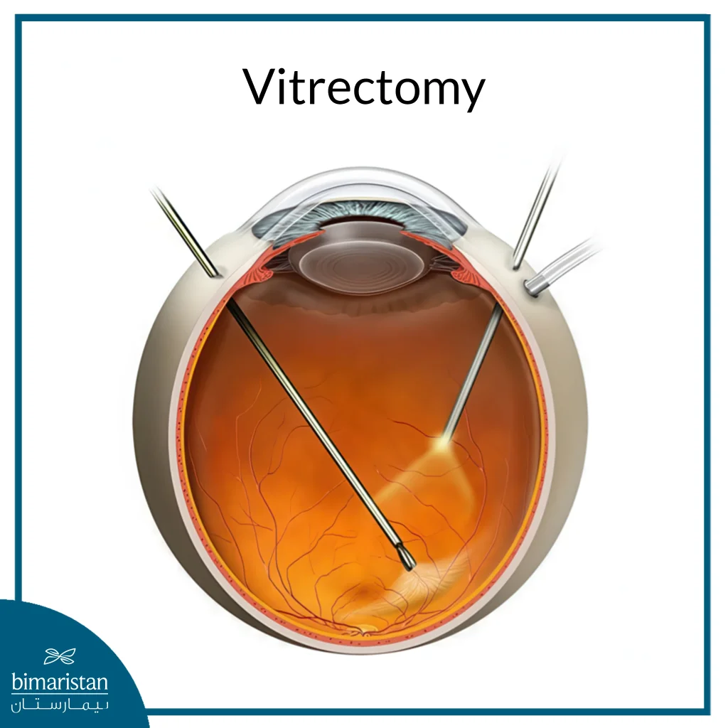 Vitrectomy In Türkiye: Procedure, Risks, And What Patients Need To Know 2025 2 An Image Showing The Vitrectomy Procedure And The Tools Used
