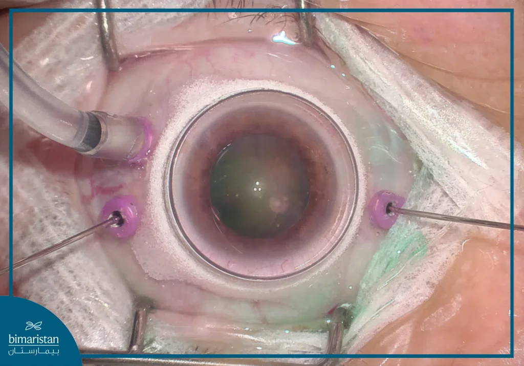 Vitrectomy In Türkiye: Procedure, Risks, And What Patients Need To Know 2025 4 Real Image Showing The Vitrectomy Procedure.