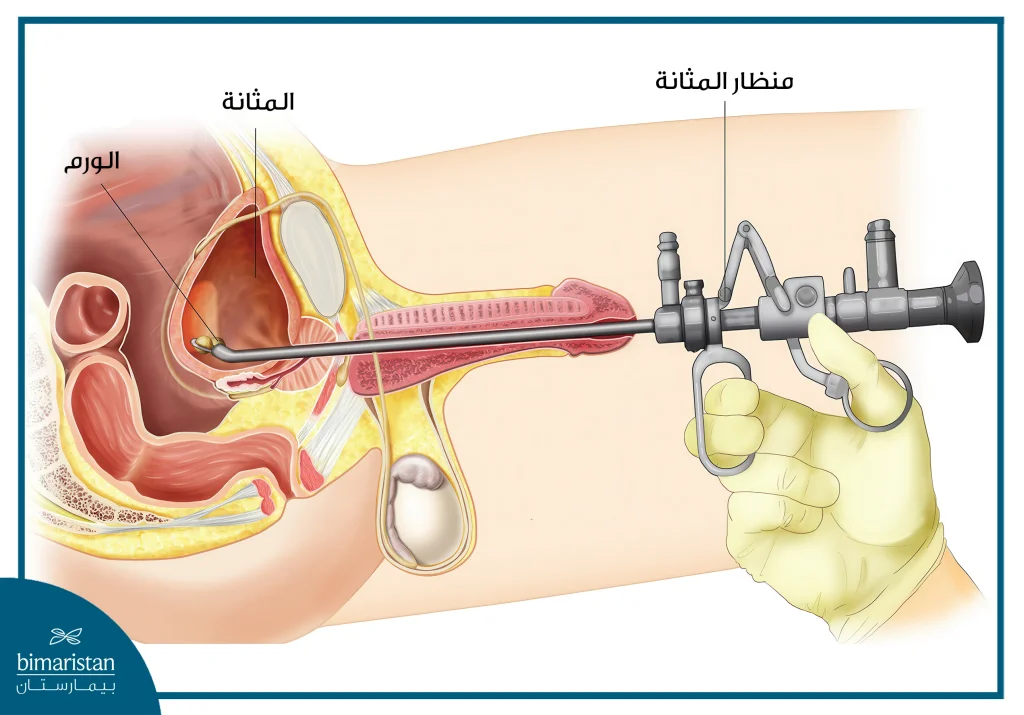 استئصال ورم المثانة عبر الإحليل (Turbt) 2 عملية استئصال ورم المثانة عبر الإحليل