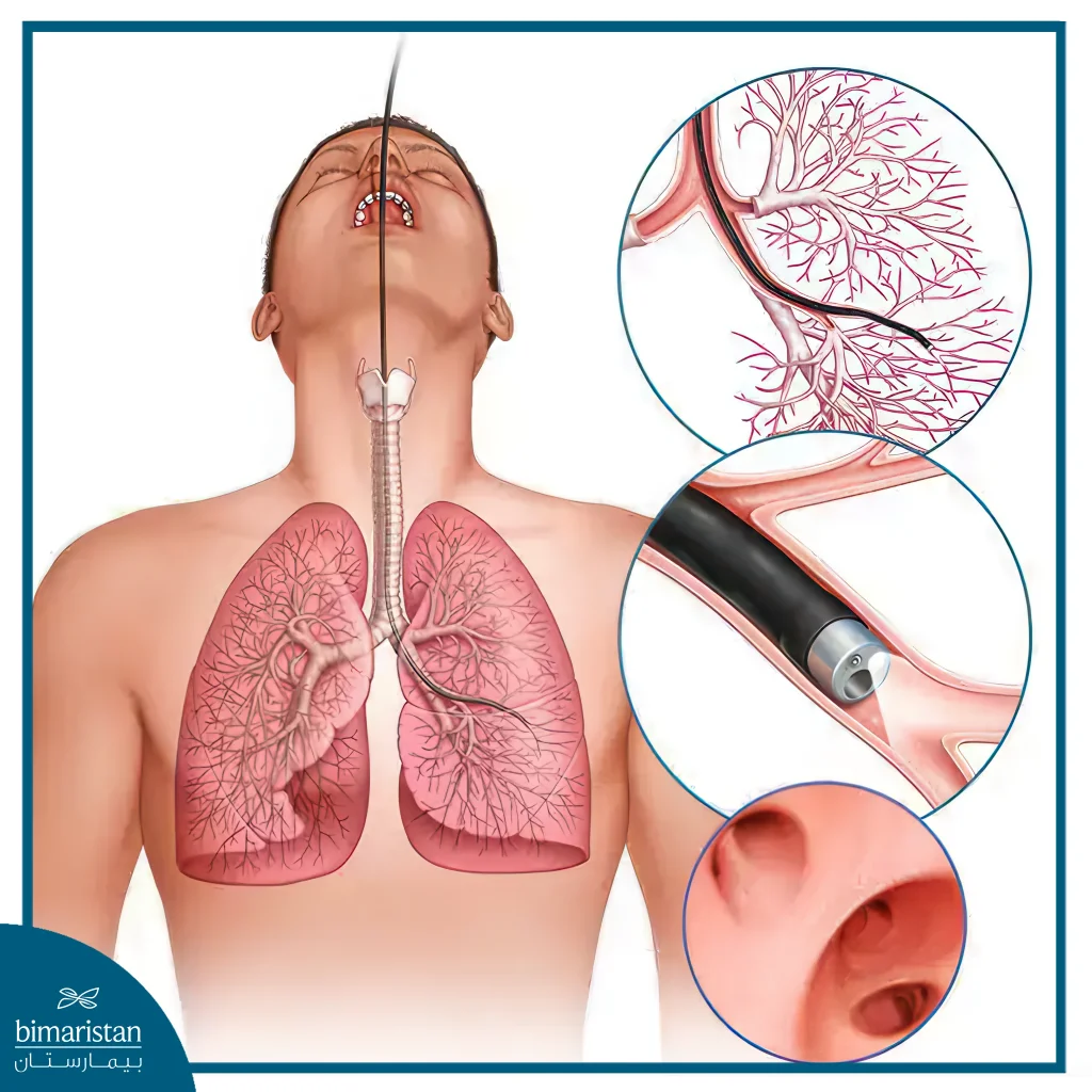 Tracheal Diseases In Turkey: Symptoms Diagnosis &Amp; Treatments 6 Bronchoscopy In Tracheal Diseases