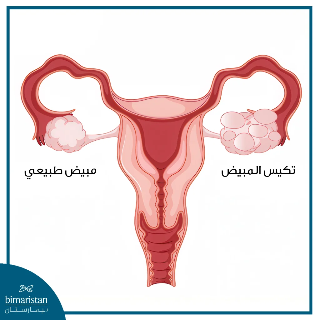 العقم: أنواعه وأسبابه وأهم علاجاته 2 تكيس المبيض
