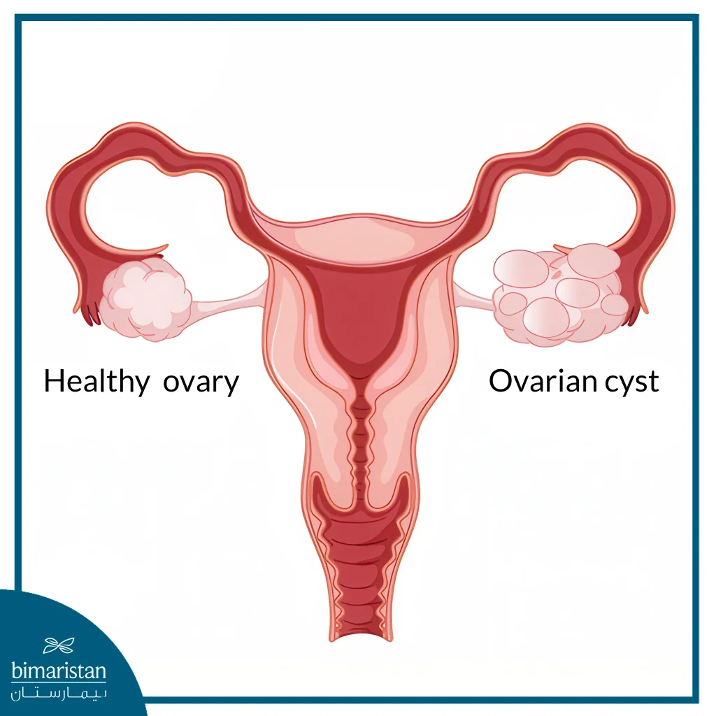Infertility: Types, Causes, And Treatments 2 Polycystic Ovary