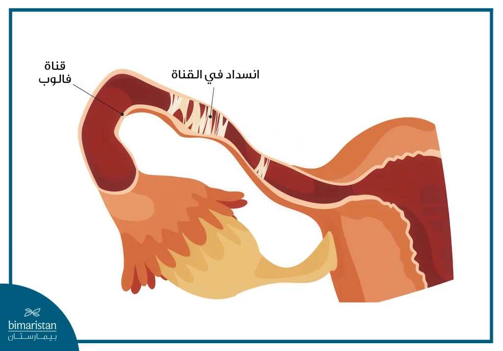 العقم: أنواعه وأسبابه وأهم علاجاته 4 انسداد قناة فالوب
