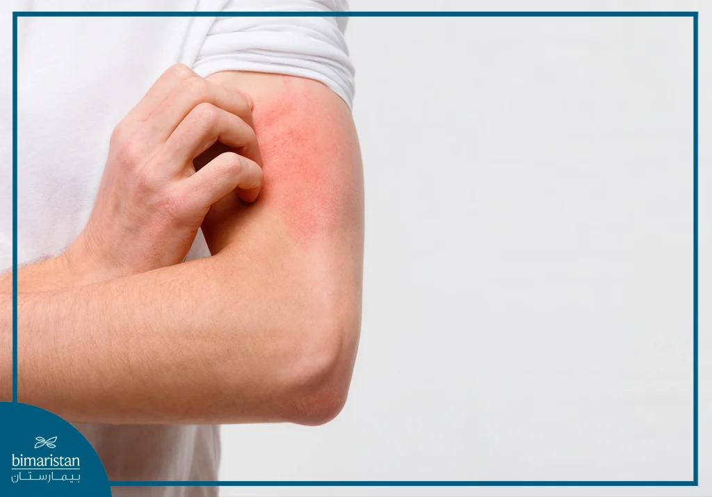 Skin Irritation After Radiation Therapy For Cancer