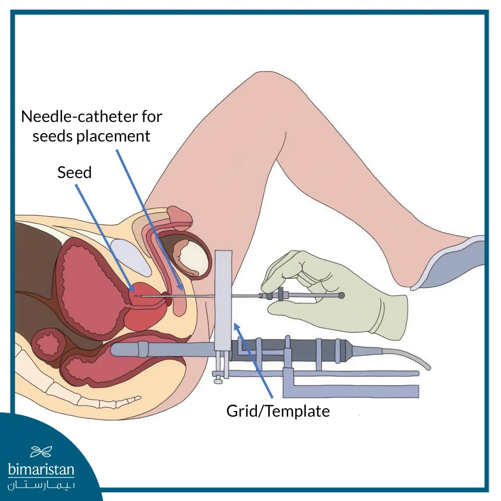 Brachytherapy Seed Implantation For Prostate Cancer