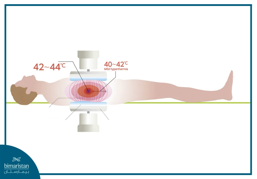 Hyperthermia Therapy For Cancer 3 Image Of How Hyperthermia Therapy Works For Cancer, Focusing Heat On The Tumor Area.