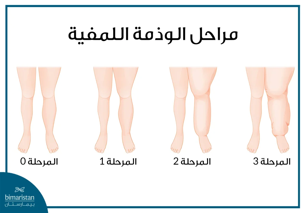 العلاج الفيزيائي للوذمة اللمفية: الشفاء بالحركة 2 مراحل الوذمة اللمفية