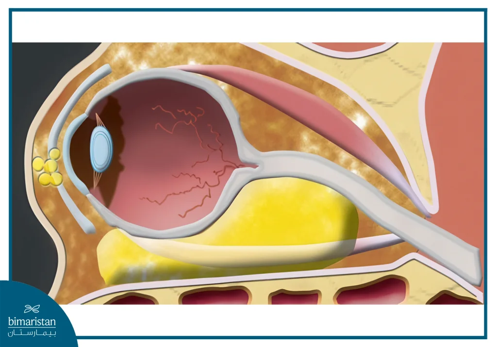 Lymphangioma: Causes, Symptoms, And Best Treatment Options 4 Lymphangioma May Be Located In The Eye Socket, Causing Compressive Visual Symptoms.