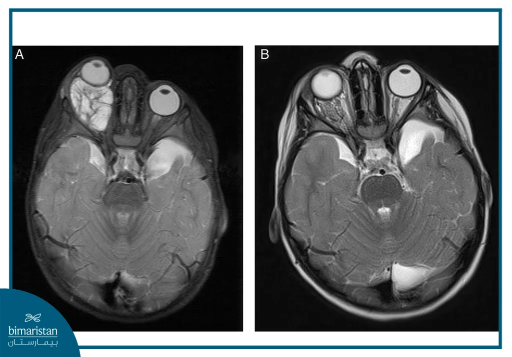 الورم الوعائي اللمفي: ما هو وطرق علاجه 5 تم أخذ صورة رنين مغناطيسي Mri لمريض مصاب بورم وعائي لمفاوي خلف عينه، وتمت إعادة الصورة بعد علاجه بالتصليب في تركيا