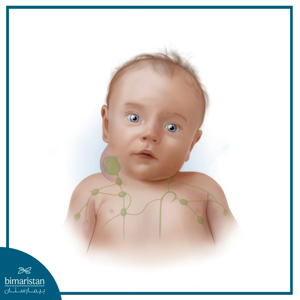 Lymphangioma: Causes, Symptoms, And Best Treatment Options 3 Illustration Of A Child With A Large Lymphangioma In His Neck (Cystic Hygroma).