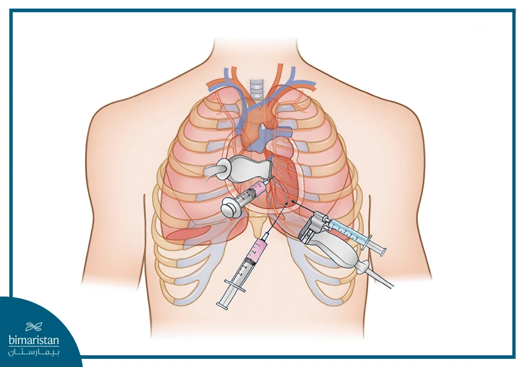 Pericardial Effusion In Turkey: Causes &Amp; Treatment Guide 4 Pericardiocentesis Is Sometimes Therapeutic, As In The Case Of Pericardial Effusion.