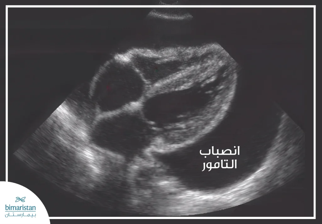انصباب التامور: الأسباب و طرق العلاج 4 يقسم كيس التامور إلى طبقة داخلية تدعى التامور الغشائي وطبقة خارجية تدعى التامور الجداري بينهما سائل