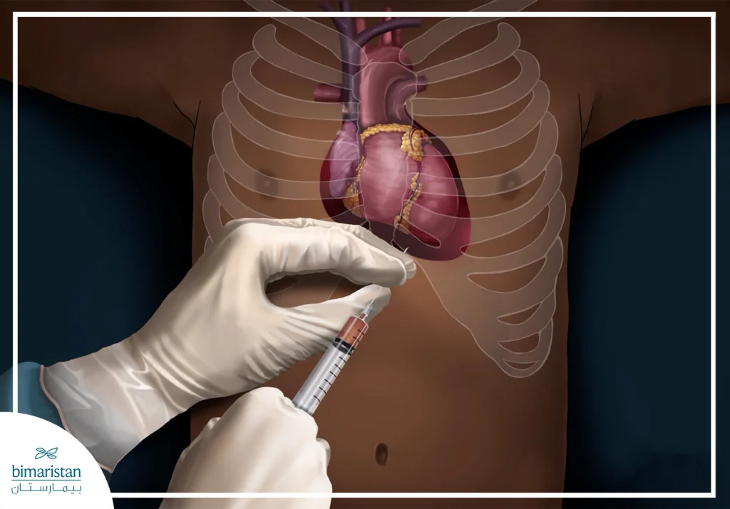 Pericardial Effusion In Turkey: Causes &Amp; Treatment Guide 5 Pericardiocentesis In Cases Of Pericardial Effusion Improves Cardiac Function.