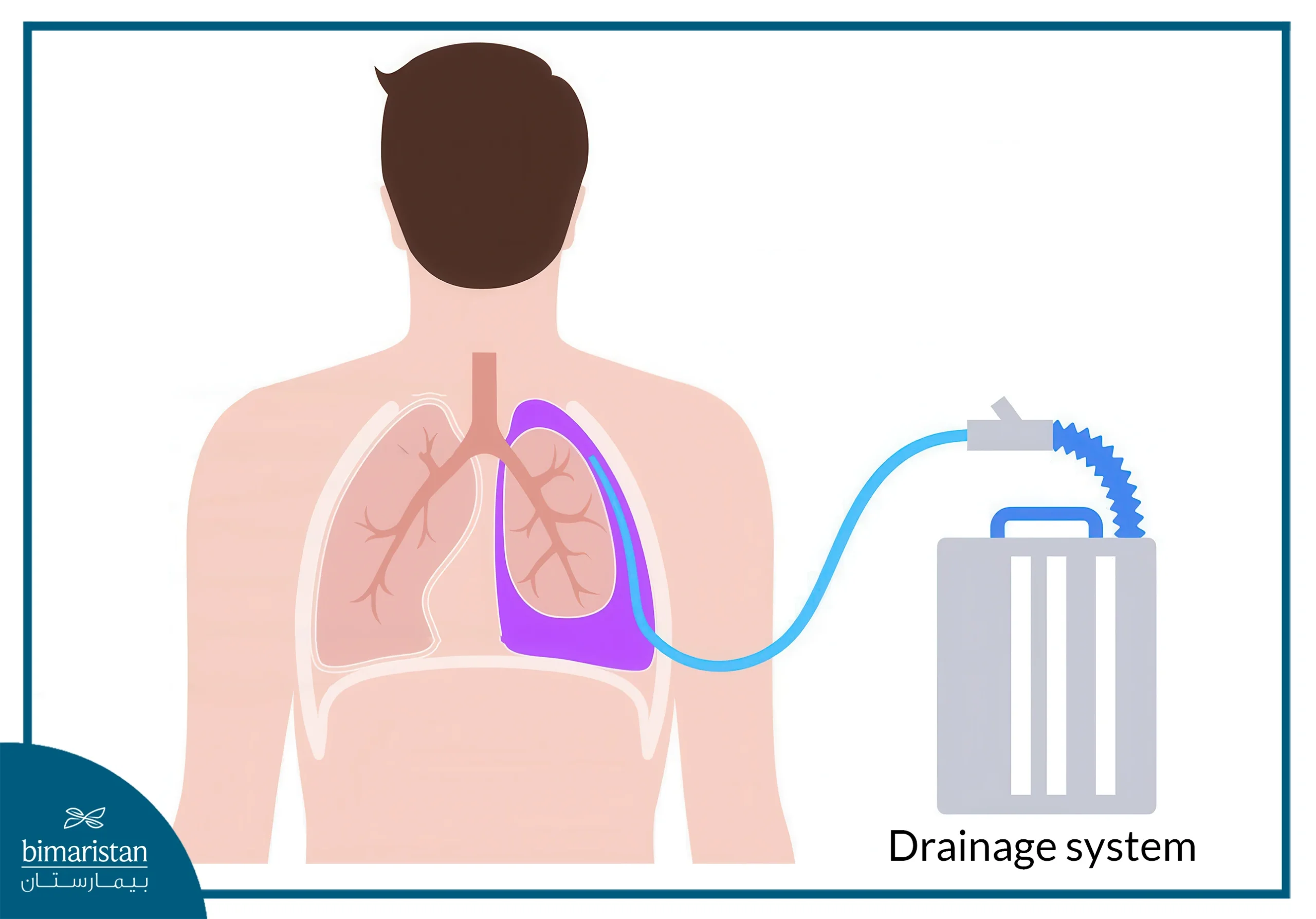 Pleural Effusion: Types And Treatment Options 6 Treatment Of Pleural Effusion With A Fluid Drainage Tube (Thoracentesis)