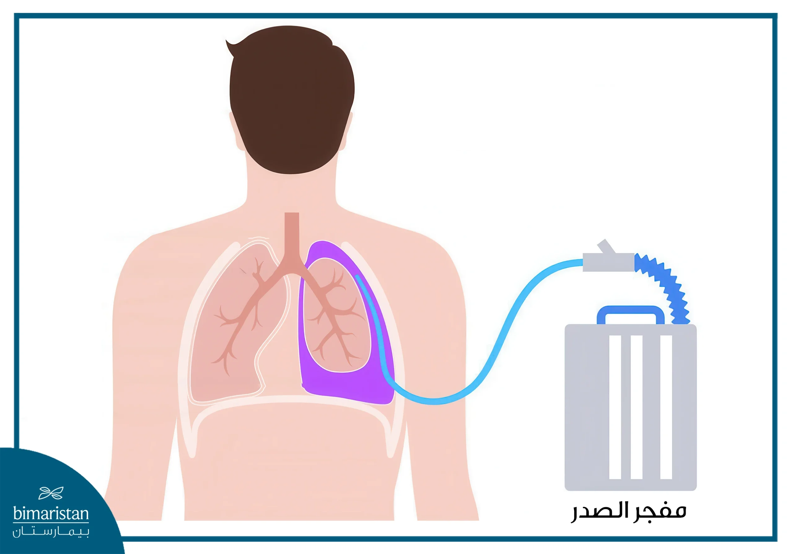 أنواع الانصباب الجنبي وطريقة علاجه 7 علاج الانصباب الجنبي عبر أنبوب تصريف السوائل (تفجير الصدر)