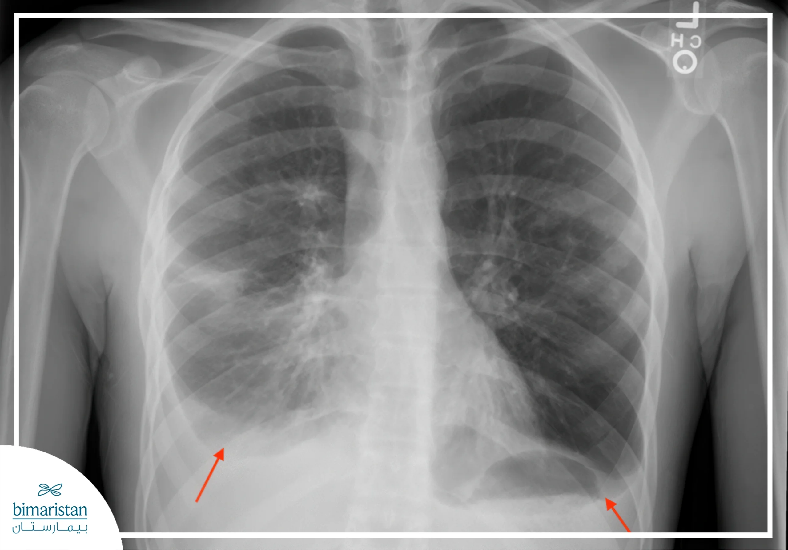Pleural Effusion: Types And Treatment Options 4 Diagnosis Of Pleural Effusion By Chest X-Ray (Demoisier Line)