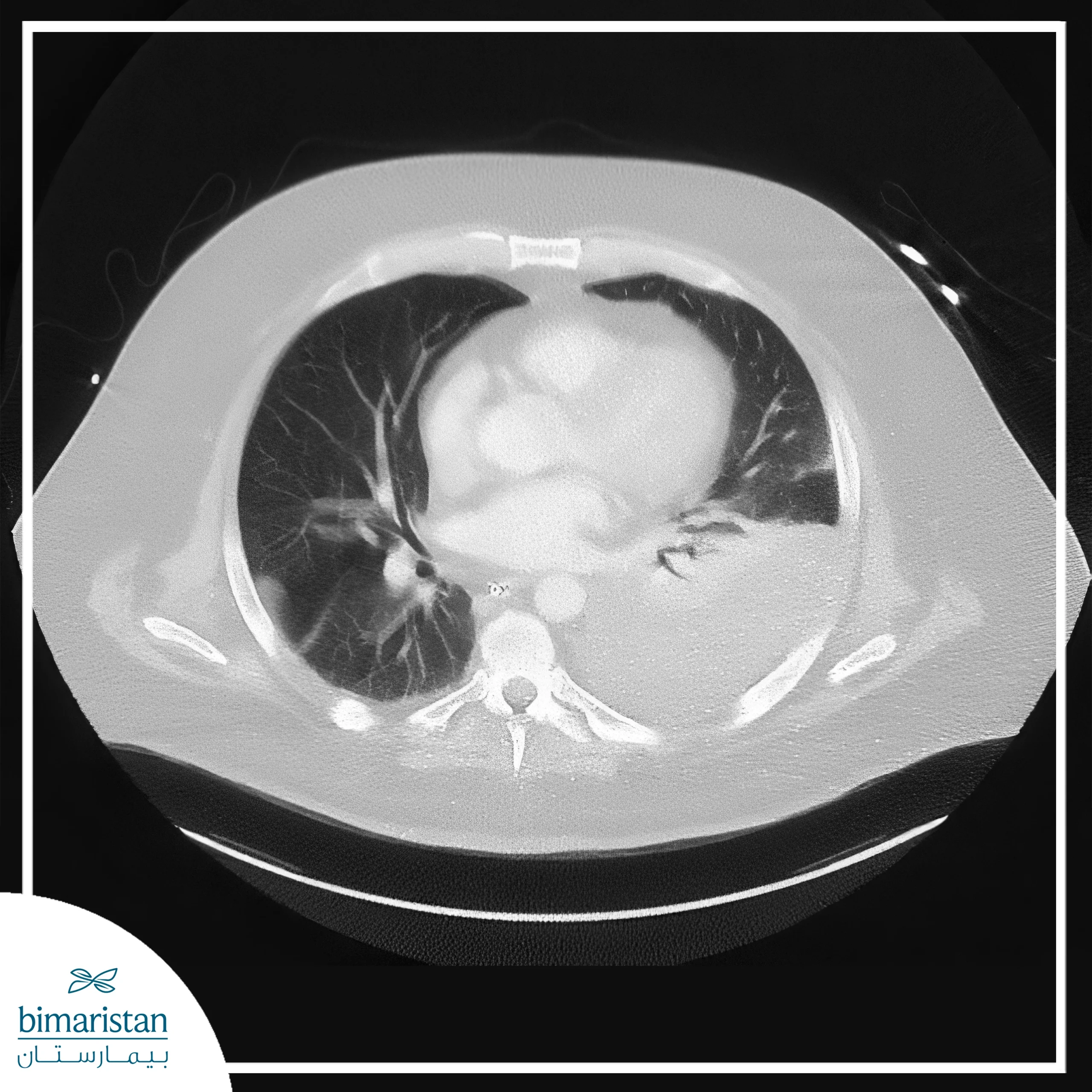 Pleural Effusion: Types And Treatment Options 5 Diagnosis Of Pleural Effusion By Chest Ct Scan