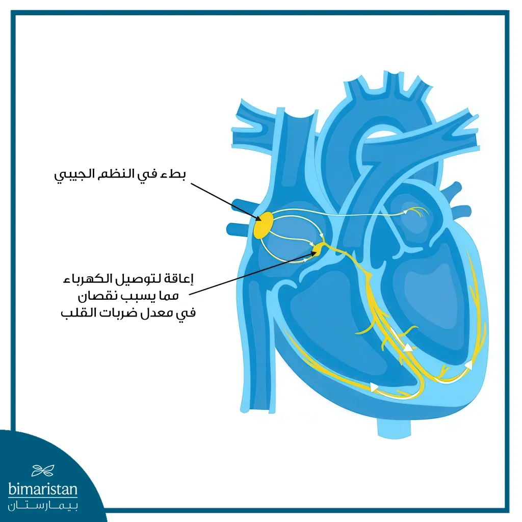 أعراض بطء نبضات القلب وعلاجه بشكل نهائي 3 يحدث بطء نبضات القلب عندما ترسل العقدة الجيبية الأذينية الإشارات ببطء شديد