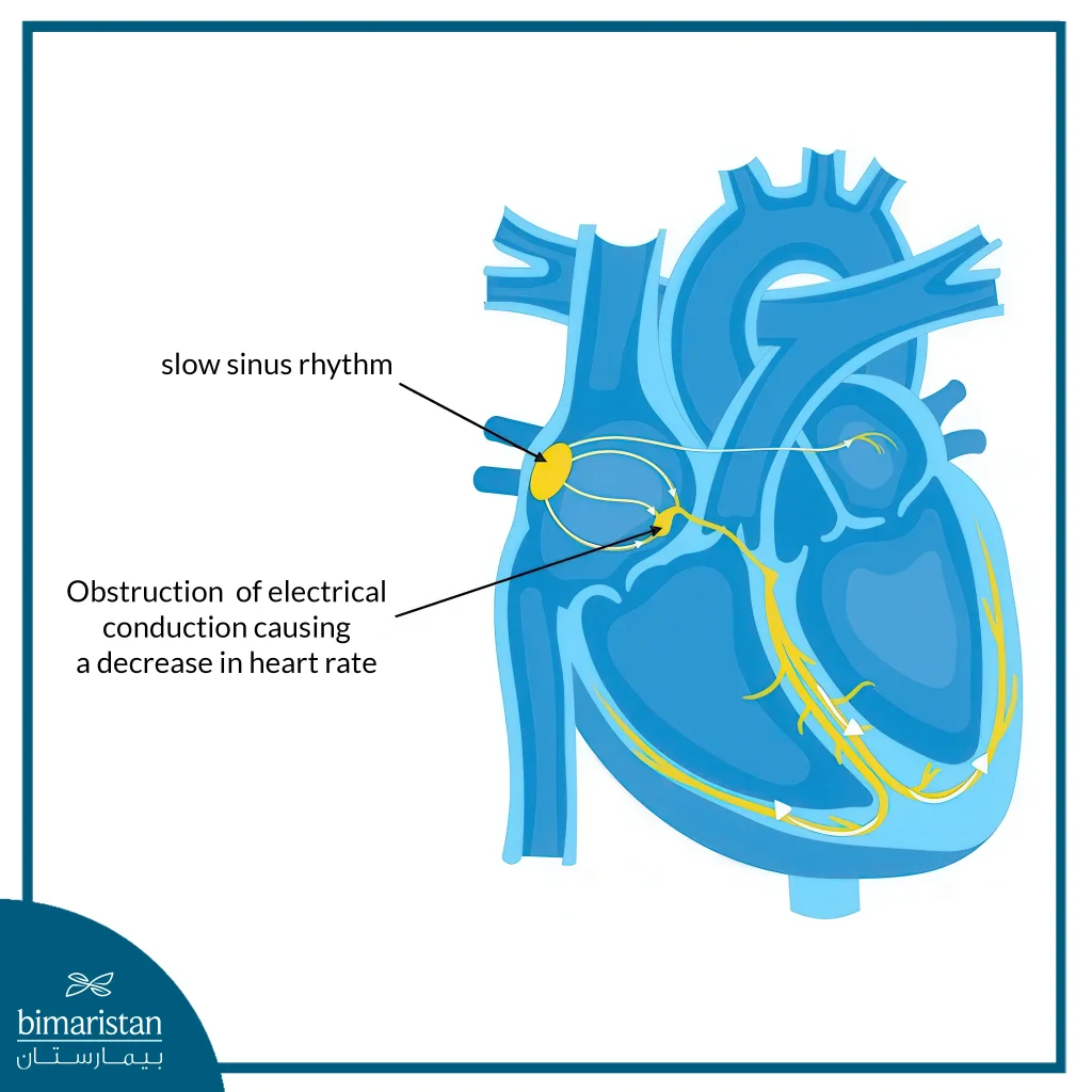 Bradycardia: Causes, Symptoms, And Best Treatment Options 3 Bradycardia Occurs When The Sinoatrial Node Sends Signals Too Slowly.