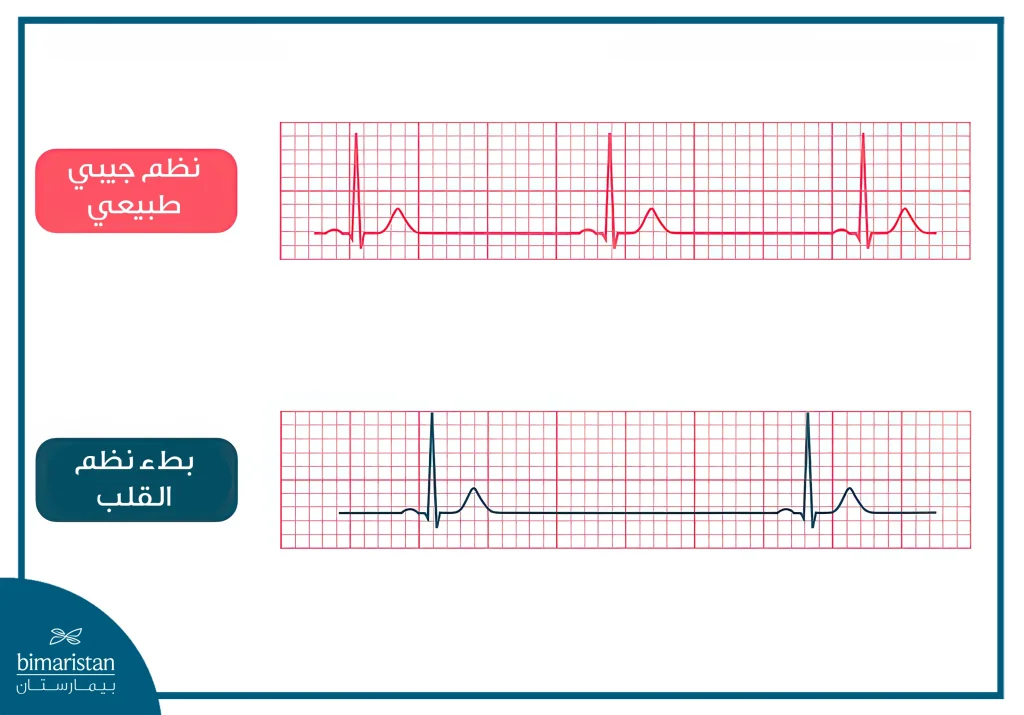 أعراض بطء نبضات القلب وعلاجه بشكل نهائي 4 نلاحظ تطاول المسافة R-R في التخطيط الكهربائي في حالة بطء نبضات القلب
