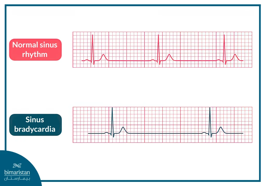 Bradycardia: Causes, Symptoms, And Best Treatment Options 4 We Notice An Elongation Of The R-R Distance In The Electrocardiogram In The Case Of Bradycardia.