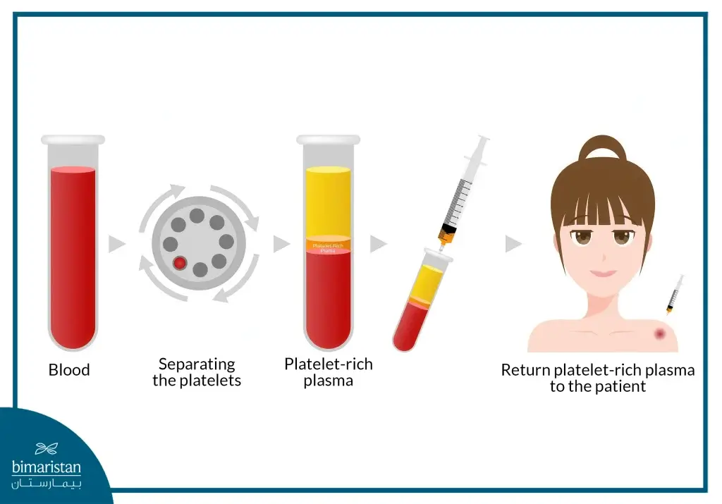 Benefits Of Prp For Hair And Face In Turkey 4 A Picture Illustrating How Plasma Is Injected For Hair And Face