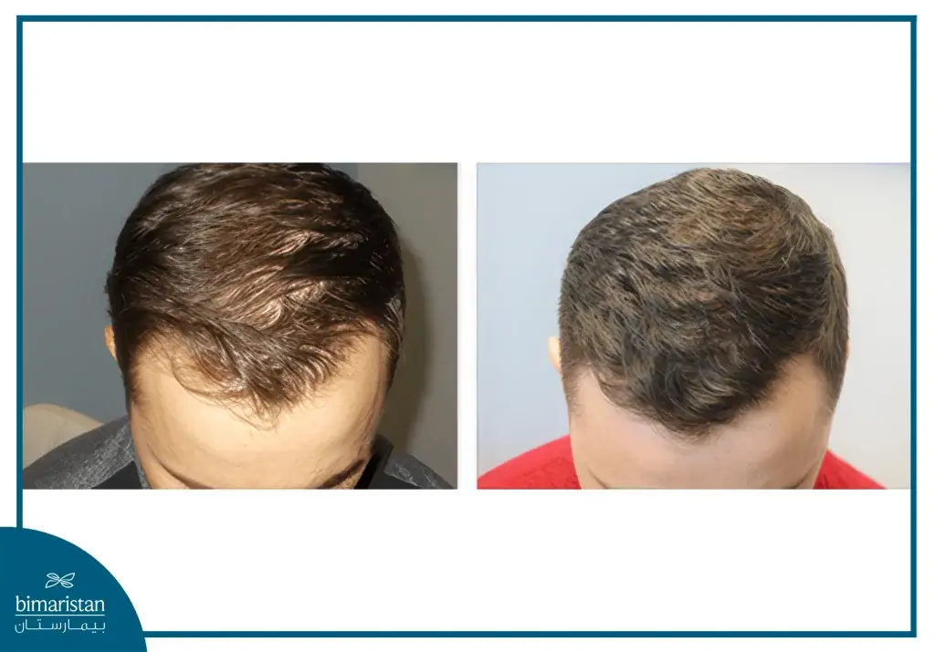 Plasma Injection For Hair After Transplantation In Turkey 4 Image Showing The Difference Before And After Plasma Injection For Hair After Transplantation