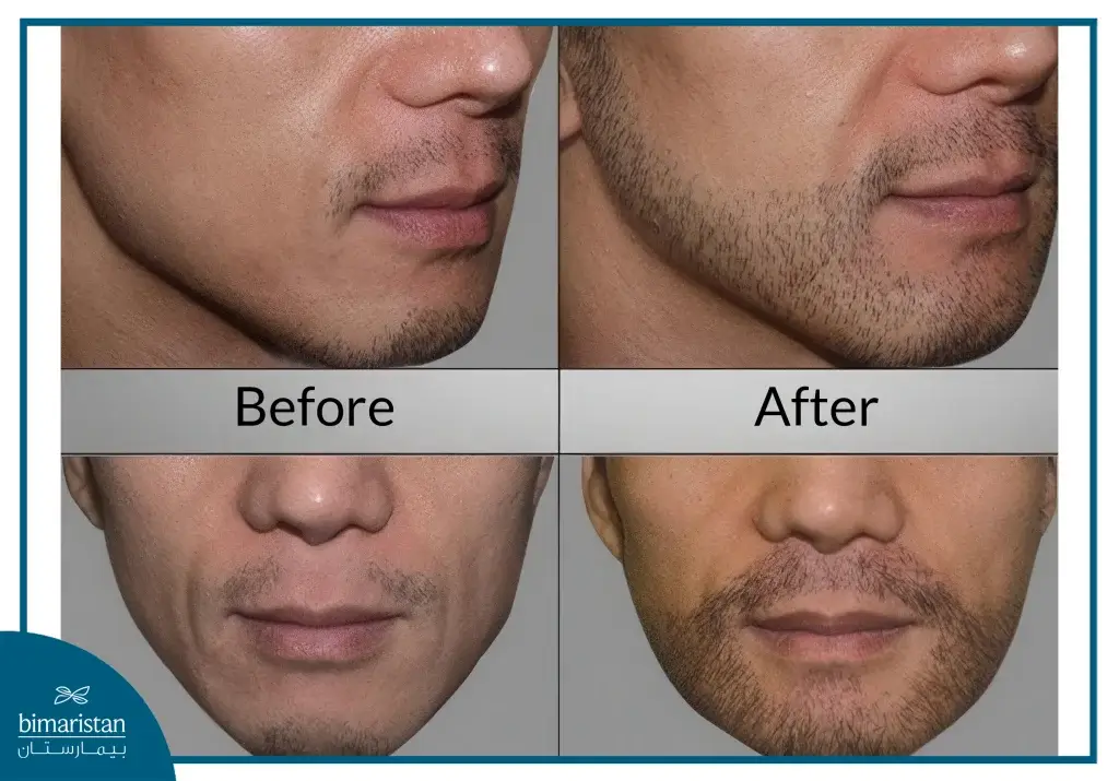 Beard Hair Transplant Surgery In Turkey 4 Before And After Beard Hair Transplant Surgery.